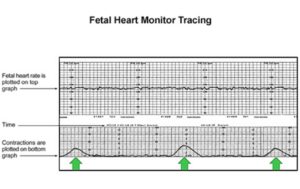 Fetal heart monitor tracing